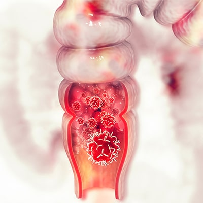 How Colorectal Cancer Is Affected By The Microbiome Atrantil