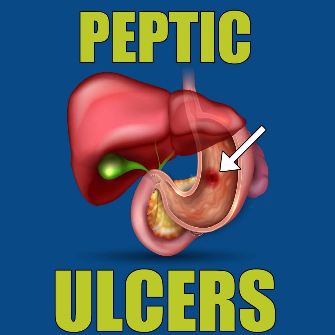 peptic-ulcers-atrantil