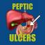 Peptic Ulcers - Atrantil